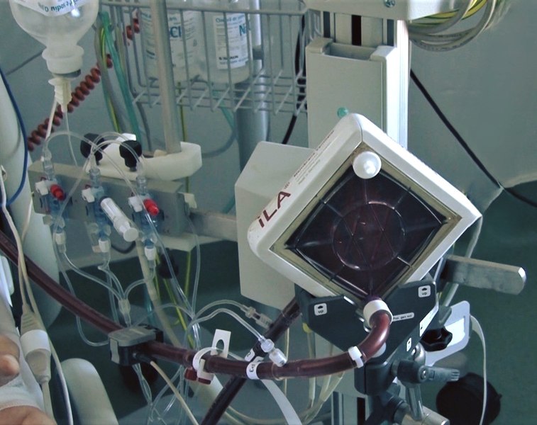 plămânul artificial finanțat - Imagine ilustrativă