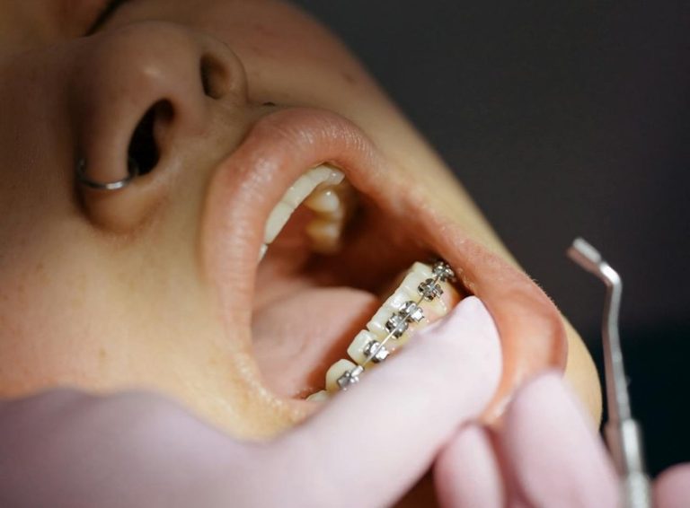 Foto reprezentând ortodonția modernă mușcătură - Știri România