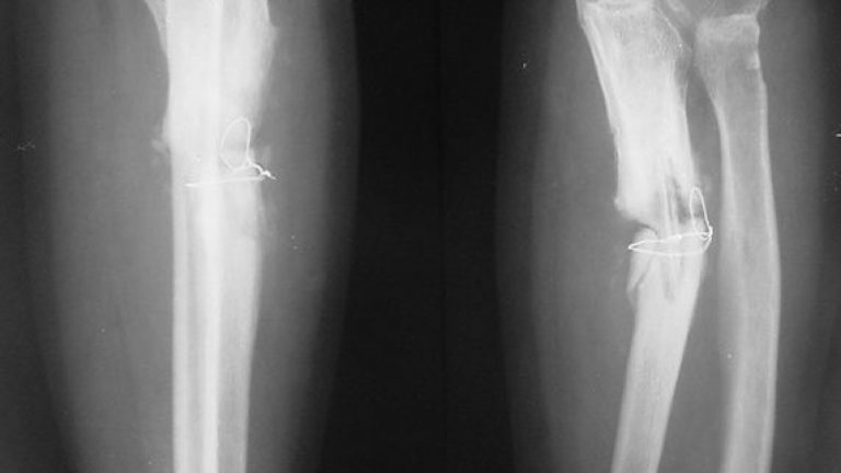 Foto reprezentând oase rupte lipite - Știri România